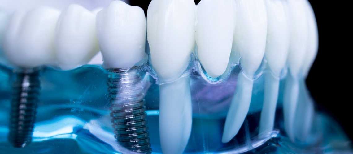 İmplant Tedavisi Fiyatları