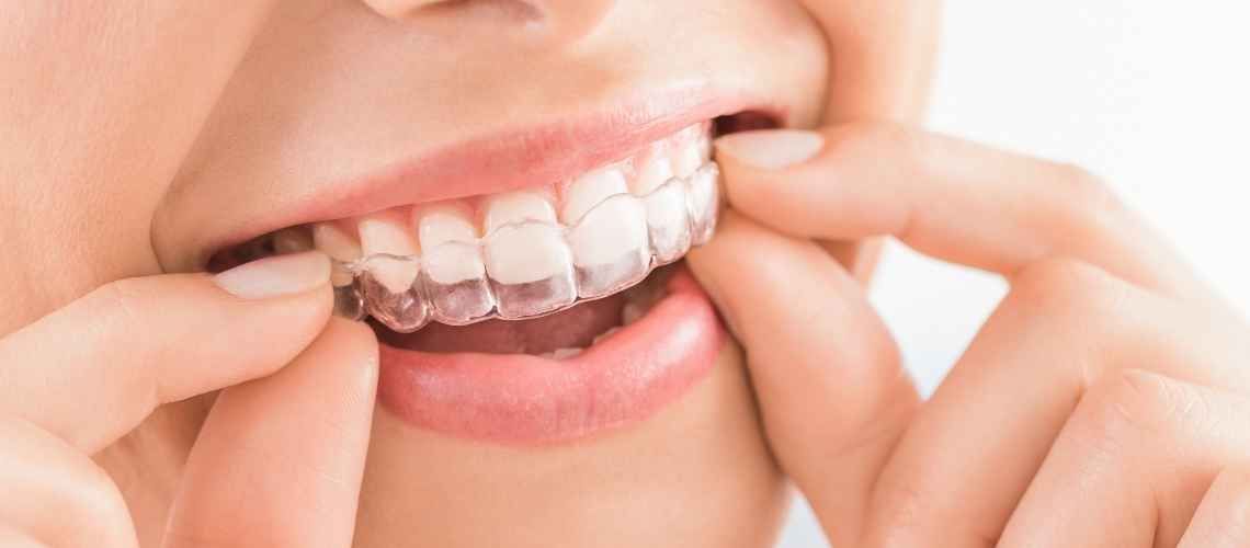 Invisalign Tedavisi Aşamaları Nelerdir?
