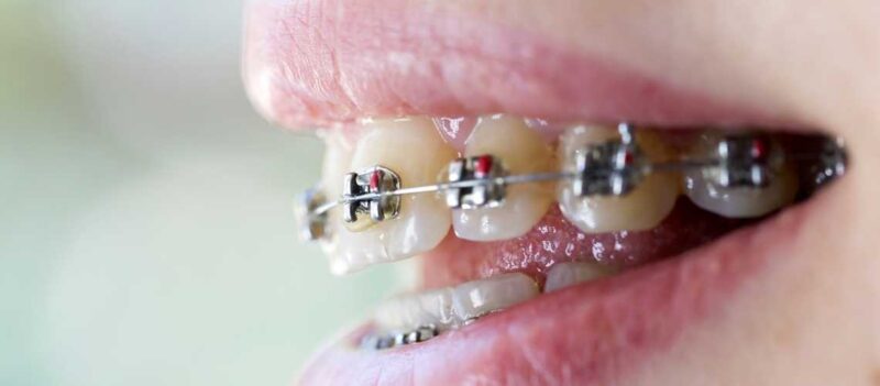 Ortodonti Tedavisinde Diş Teli Çeneyi Düzeltir Mi?