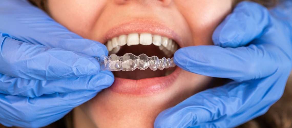 Şeffaf Plak Tedavisinde Çapraşık Dişler Nasıl Düzelir?